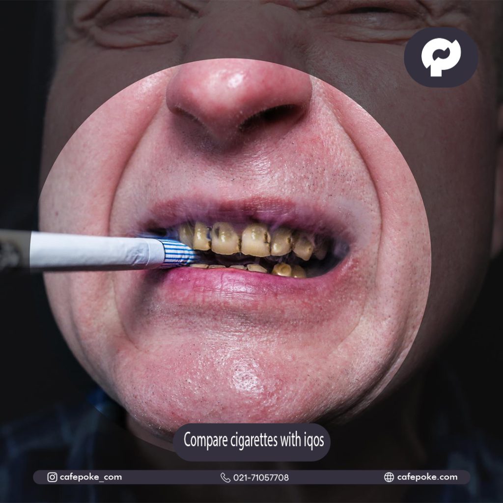 خرابی دندان بر اثر سیگار